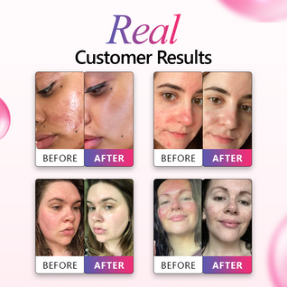 10% Azelaic Repair Serum